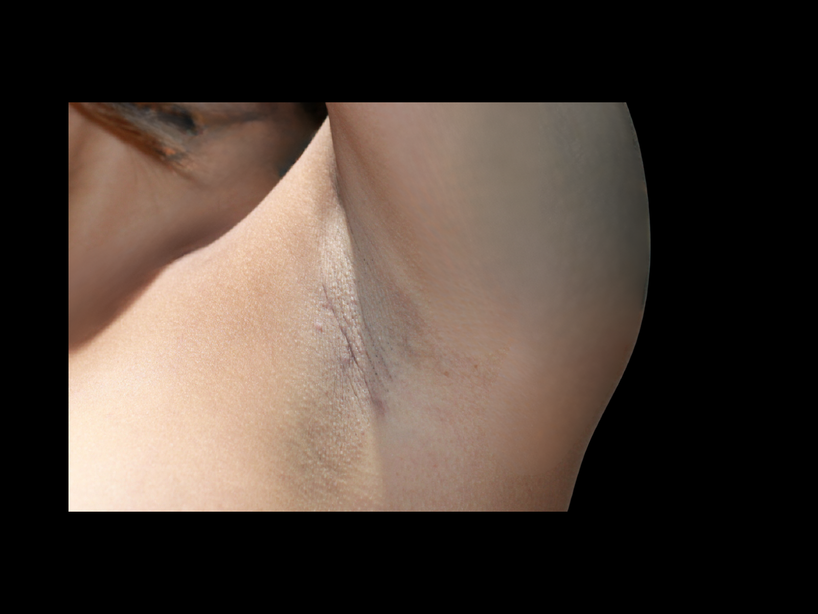dr-soler-baillo-breast-augmentation-before-and-after-scar12