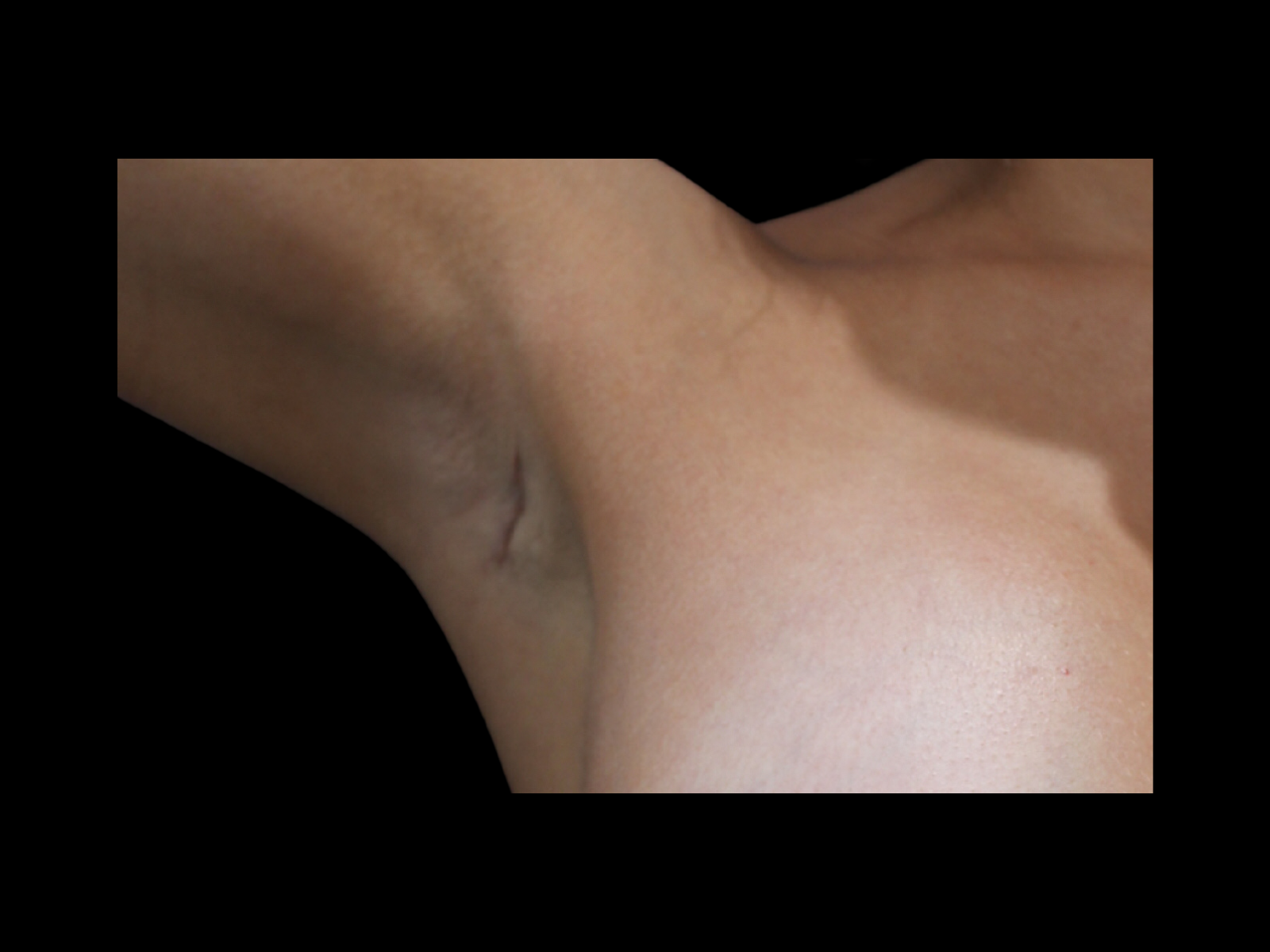 dr-soler-baillo-breast-augmentation-before-and-after-scar14