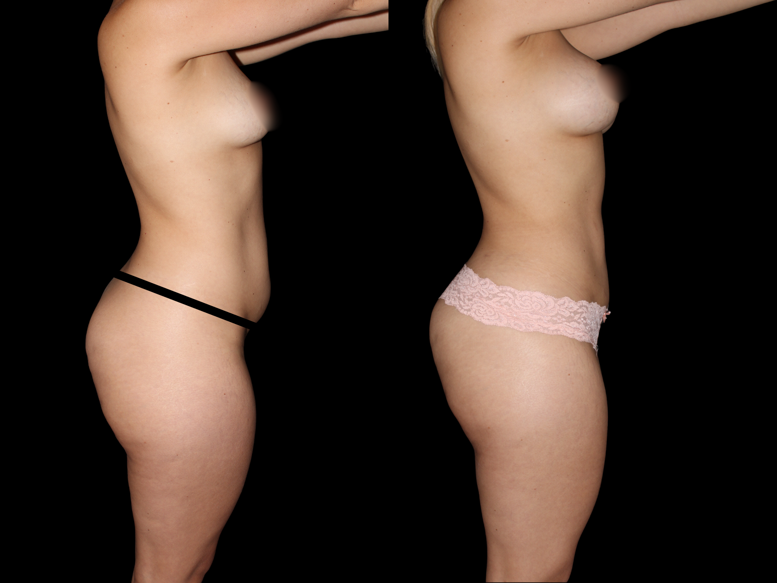 liposuction-before-and-after-coral-gables (5)