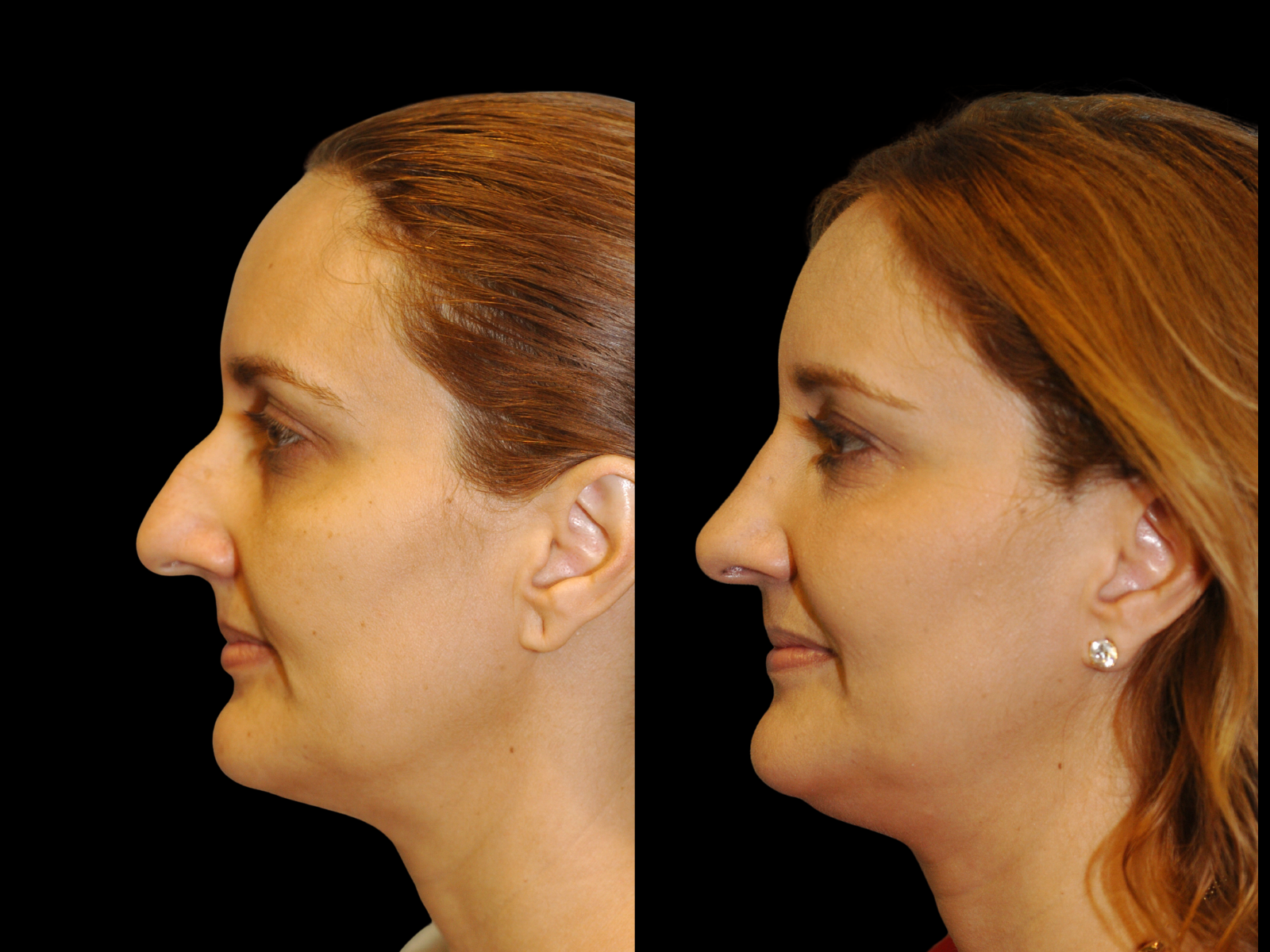 rhinoplasty-before-and-after-coral-gables (2)