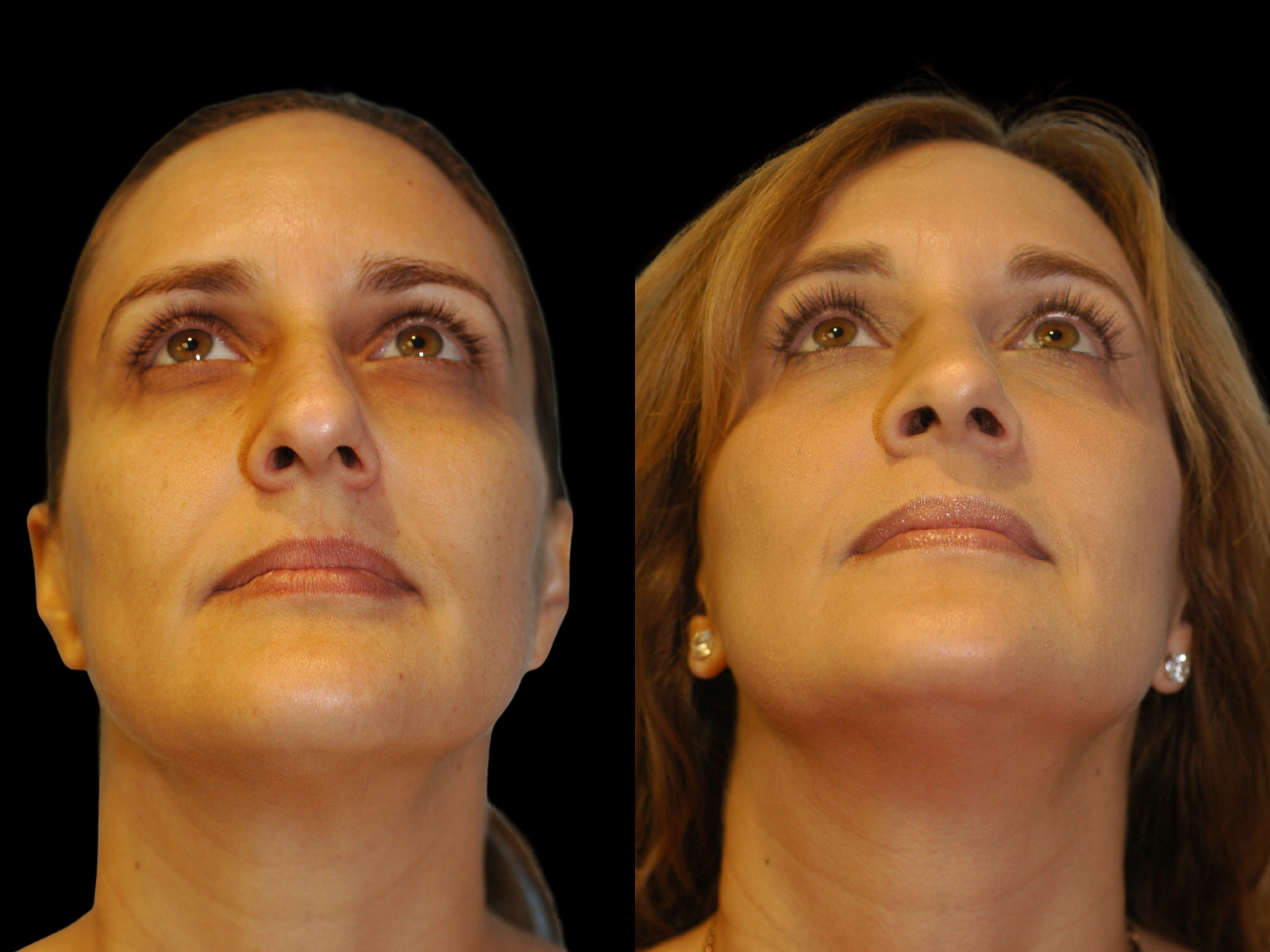 rhinoplasty-before-and-after-coral-gables