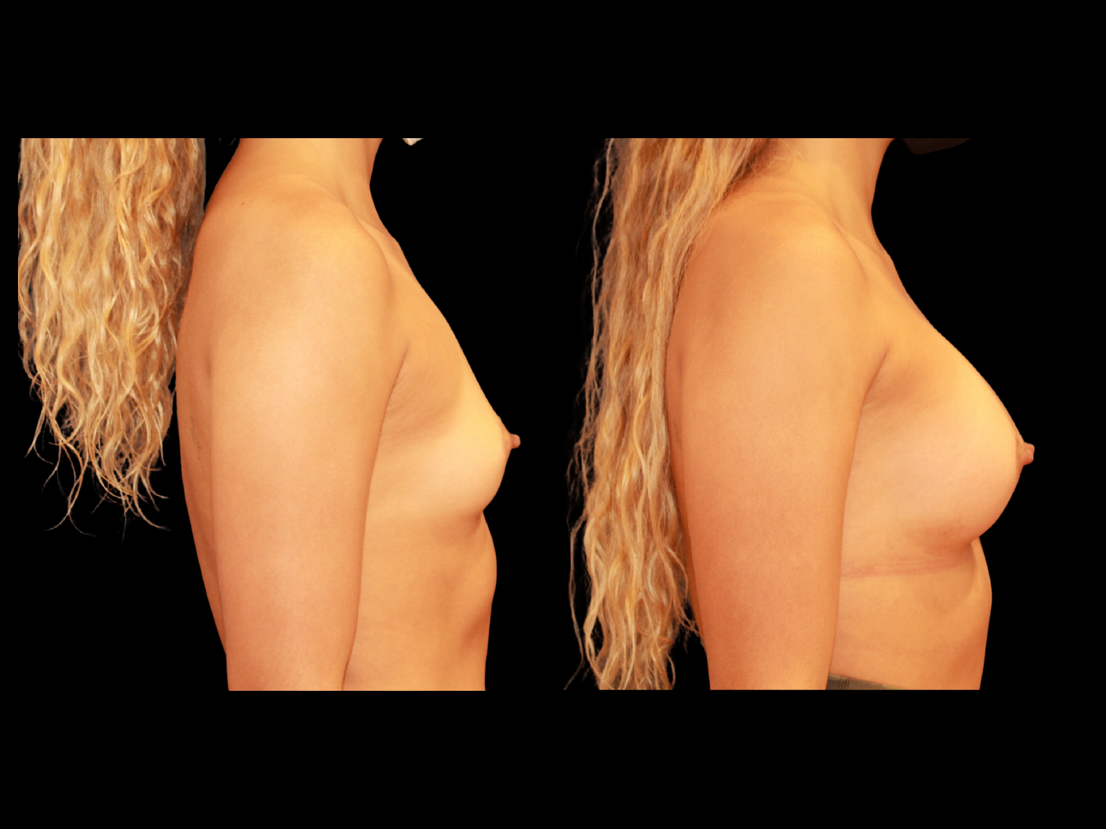 breast-aug-before-and-after-miami-ap1