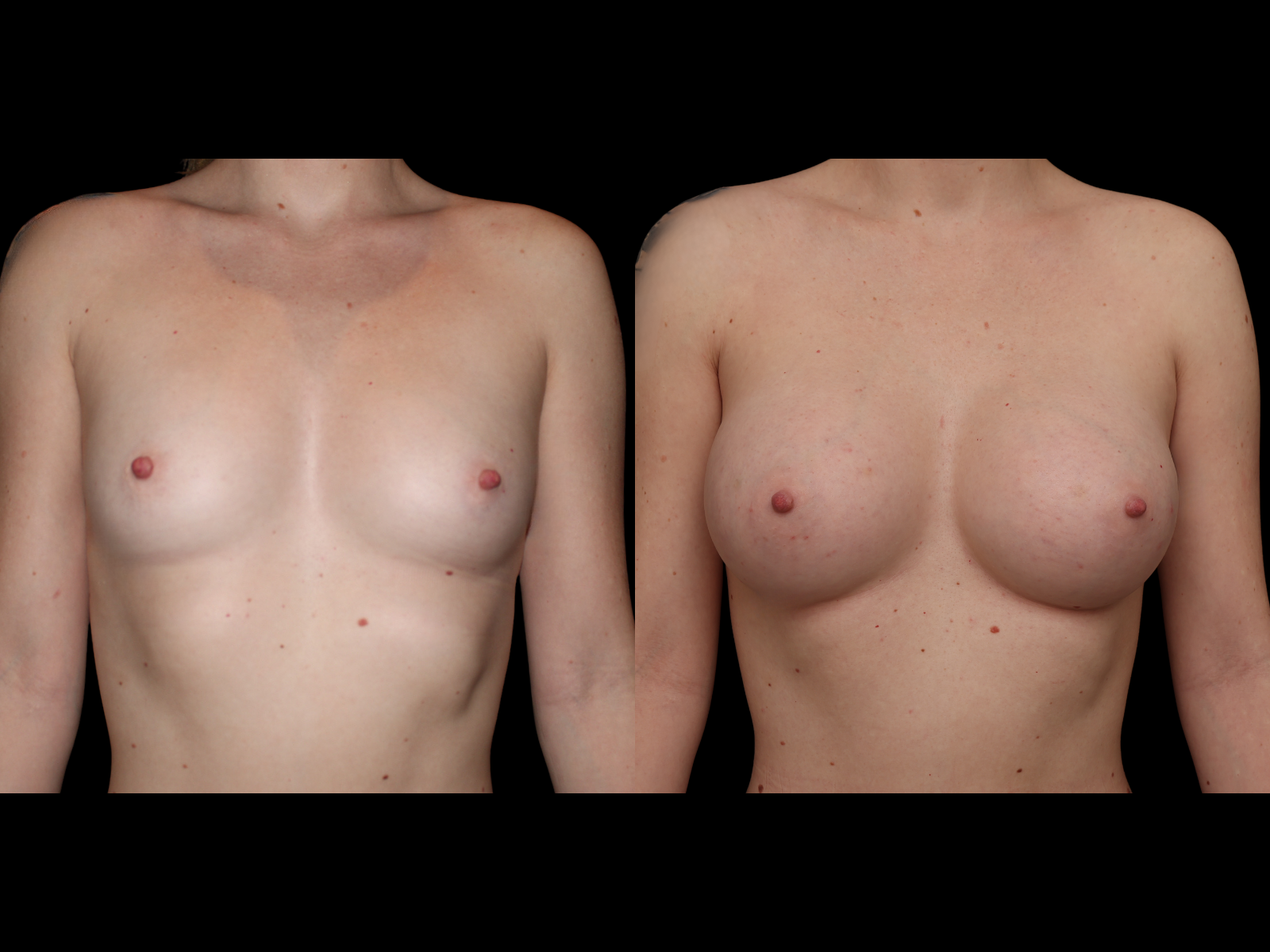 breast-aug-before-and-after-miami-hs2