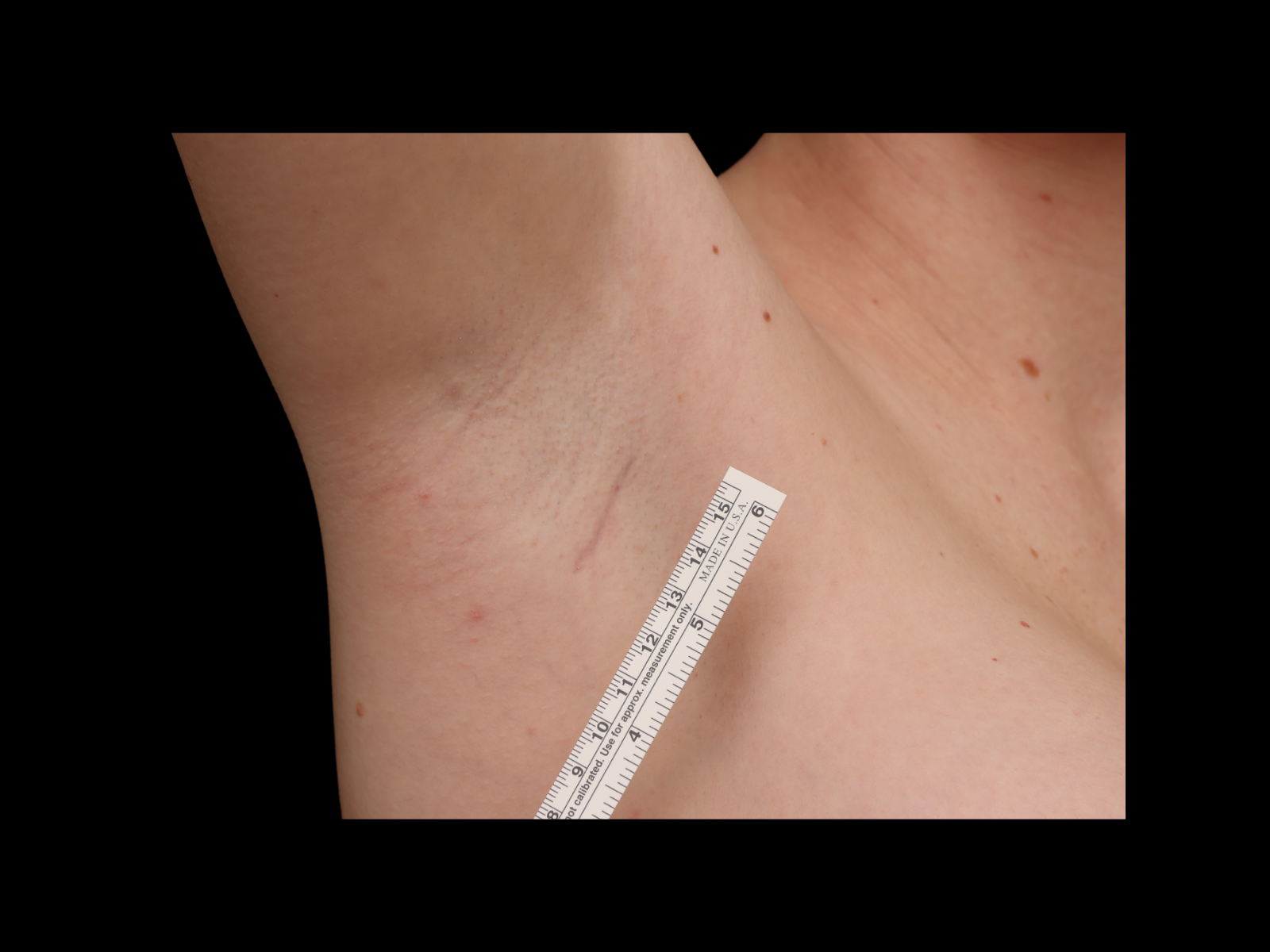 dr-soler-baillo-breast-augmentation-before-and-after-scar-hs
