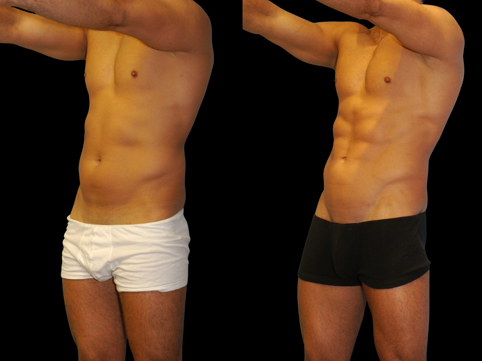 the-etch-dr-soler-baillo-miami-plastic-surgery-01b