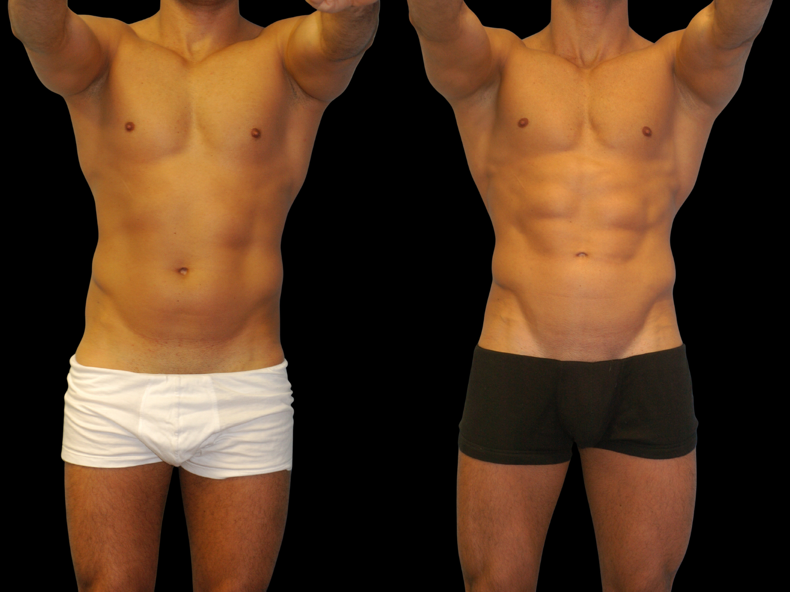 the-etch-dr-soler-baillo-miami-plastic-surgery-01c