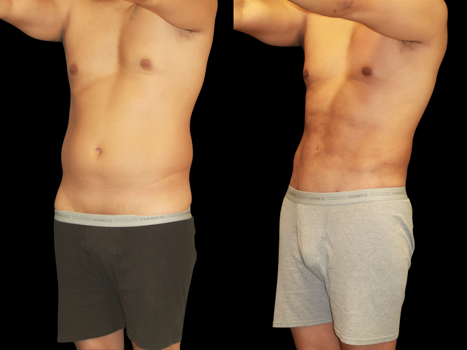the-etch-dr-soler-baillo-miami-plastic-surgery-02a