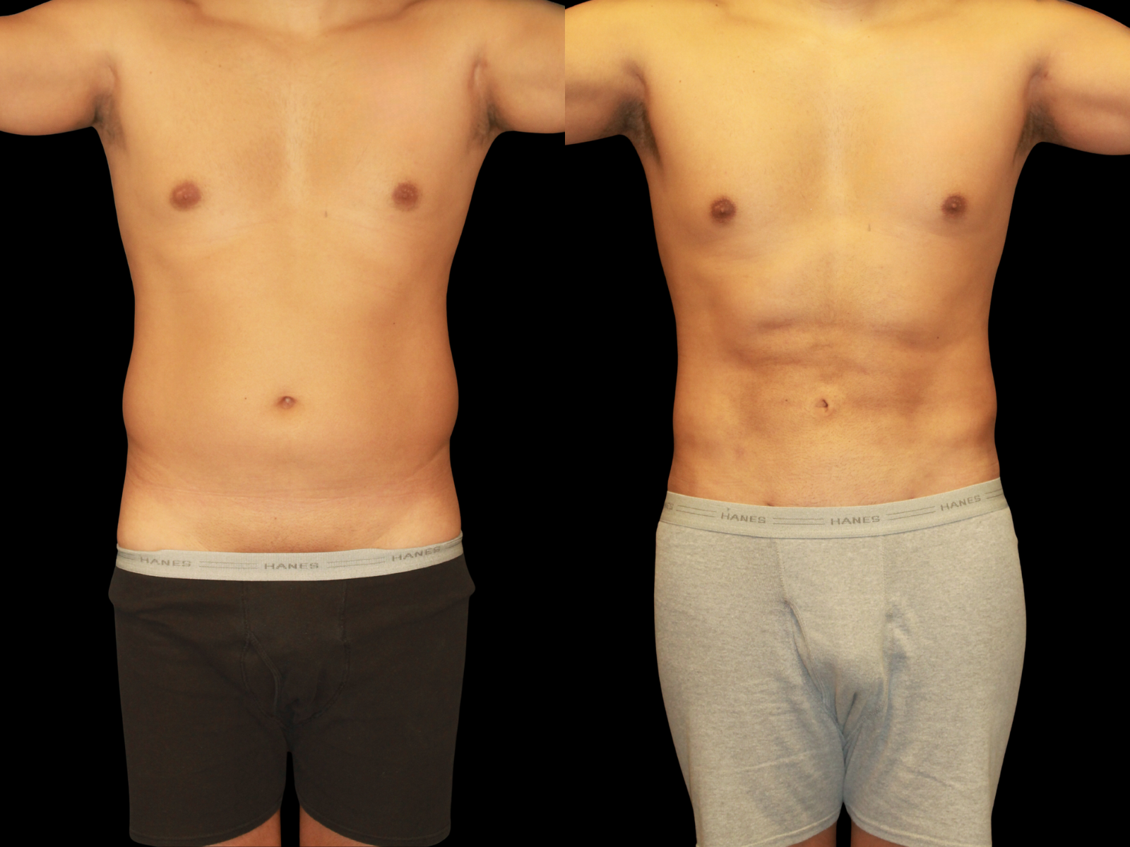 the-etch-dr-soler-baillo-miami-plastic-surgery-02c