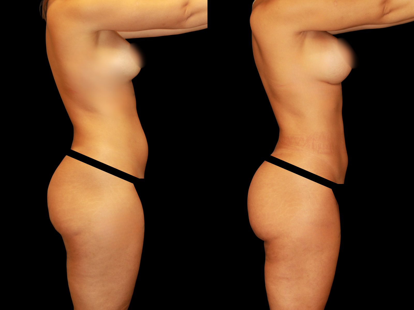 the-etch-dr-soler-baillo-miami-plastic-surgery-03b (1)