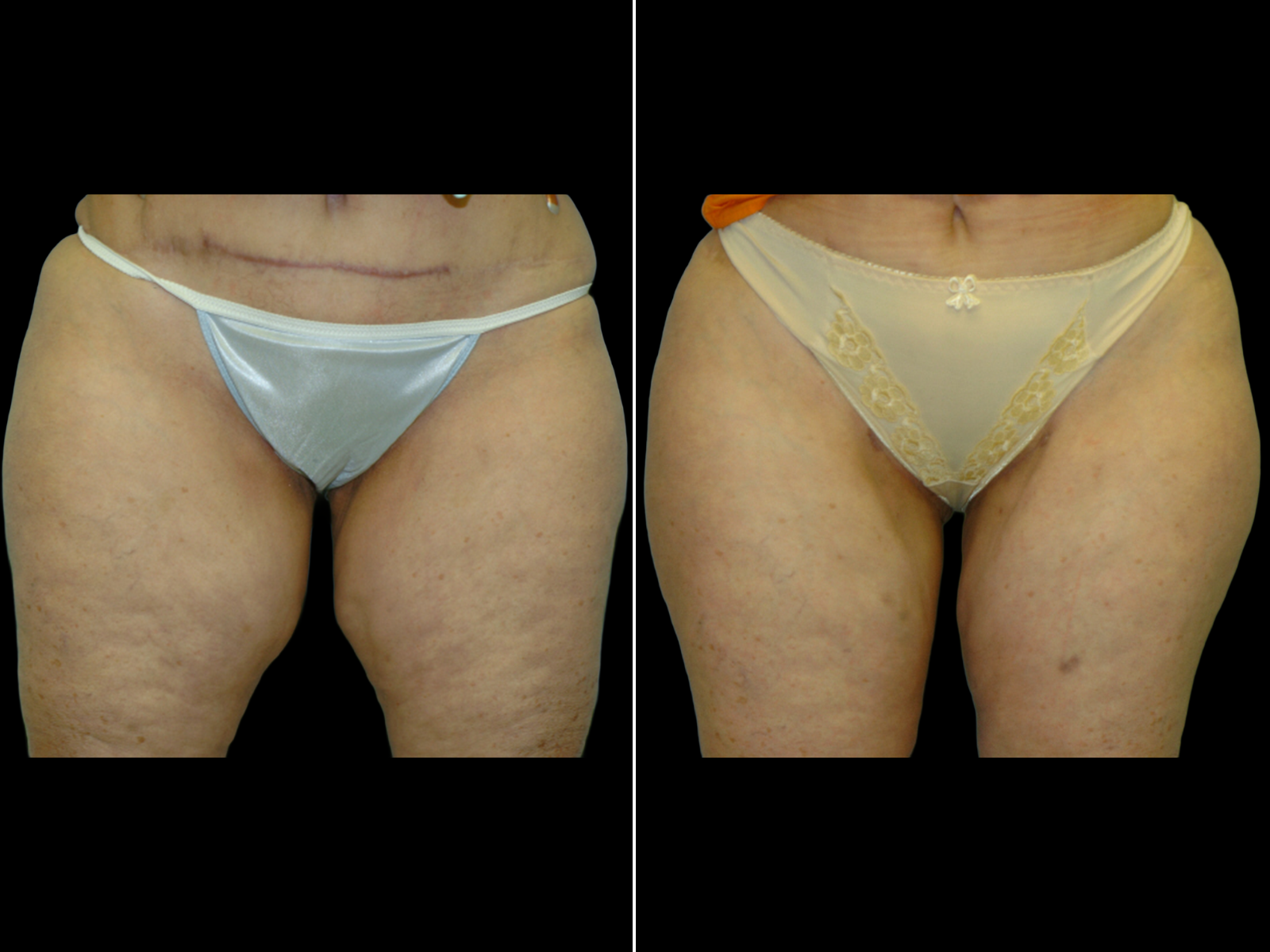 thigh-lift-before-and-after-dr-soler-baillo-coral-gables-01
