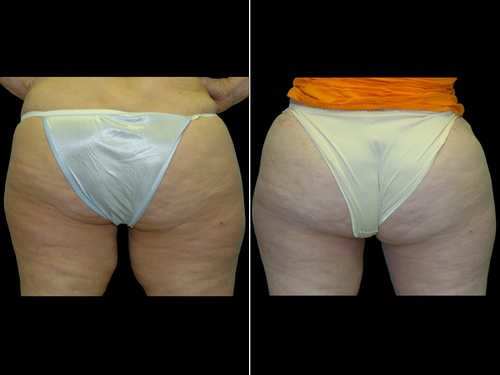 thigh-lift-before-and-after-dr-soler-baillo-coral-gables-02