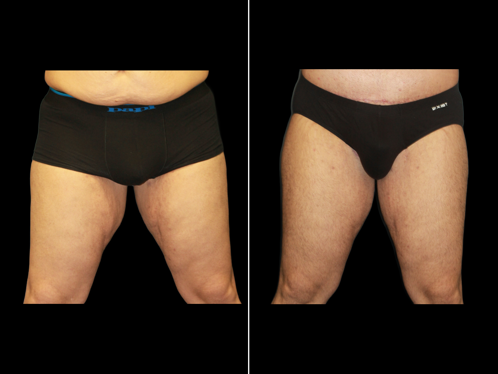 thigh-lift-before-and-after-dr-soler-baillo-coral-gables-03