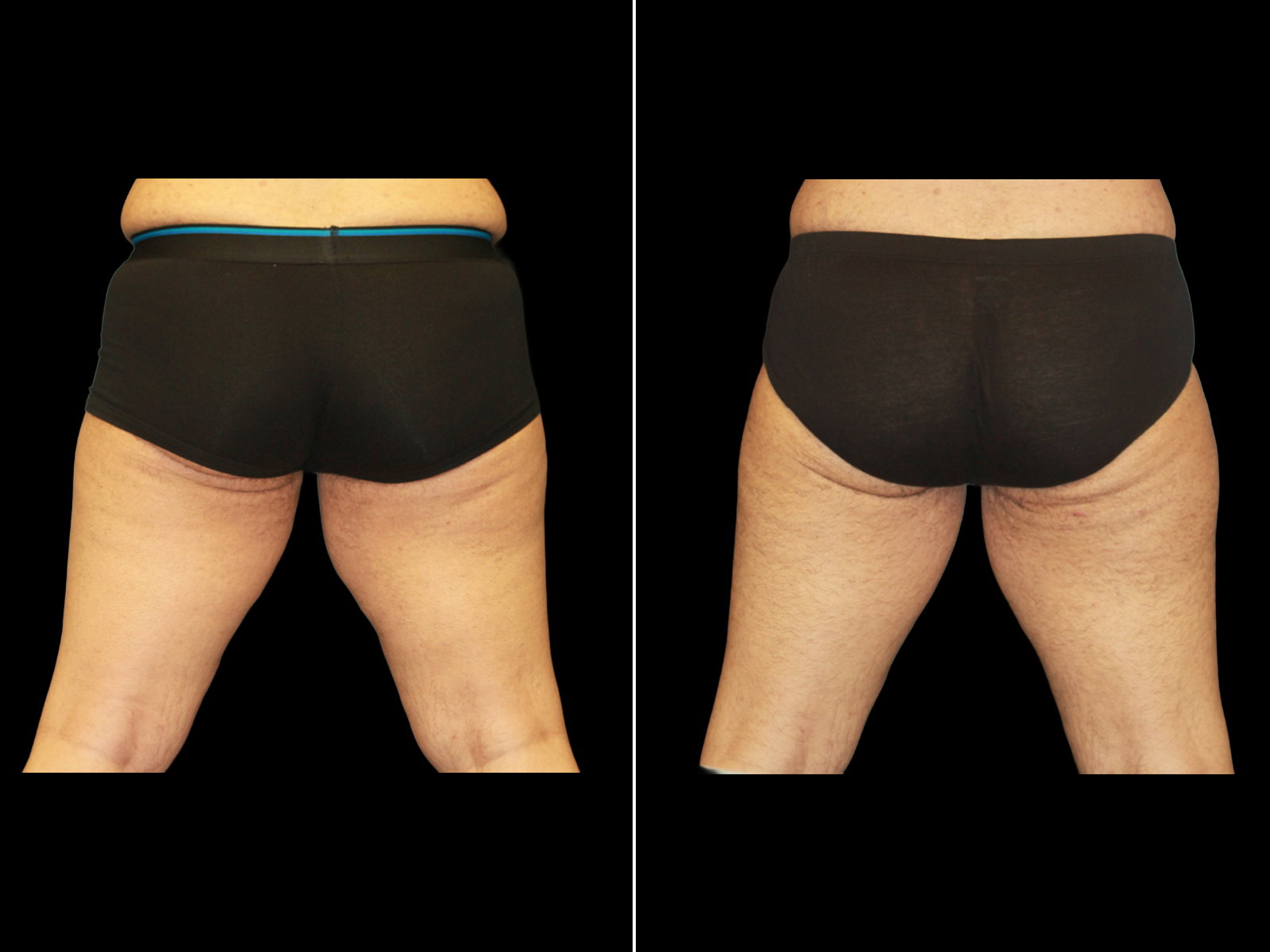 thigh-lift-before-and-after-dr-soler-baillo-coral-gables-04