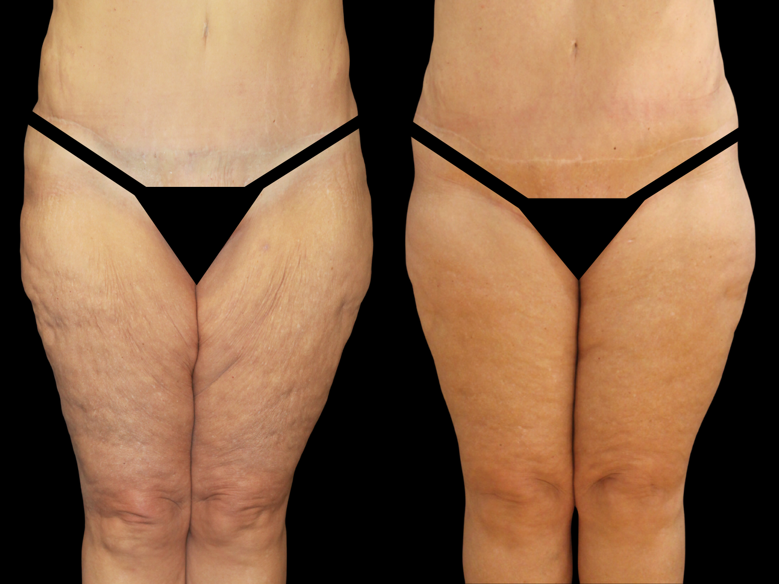 thigh-lift-dr-soler-baillo-coral-gables-before-and-after