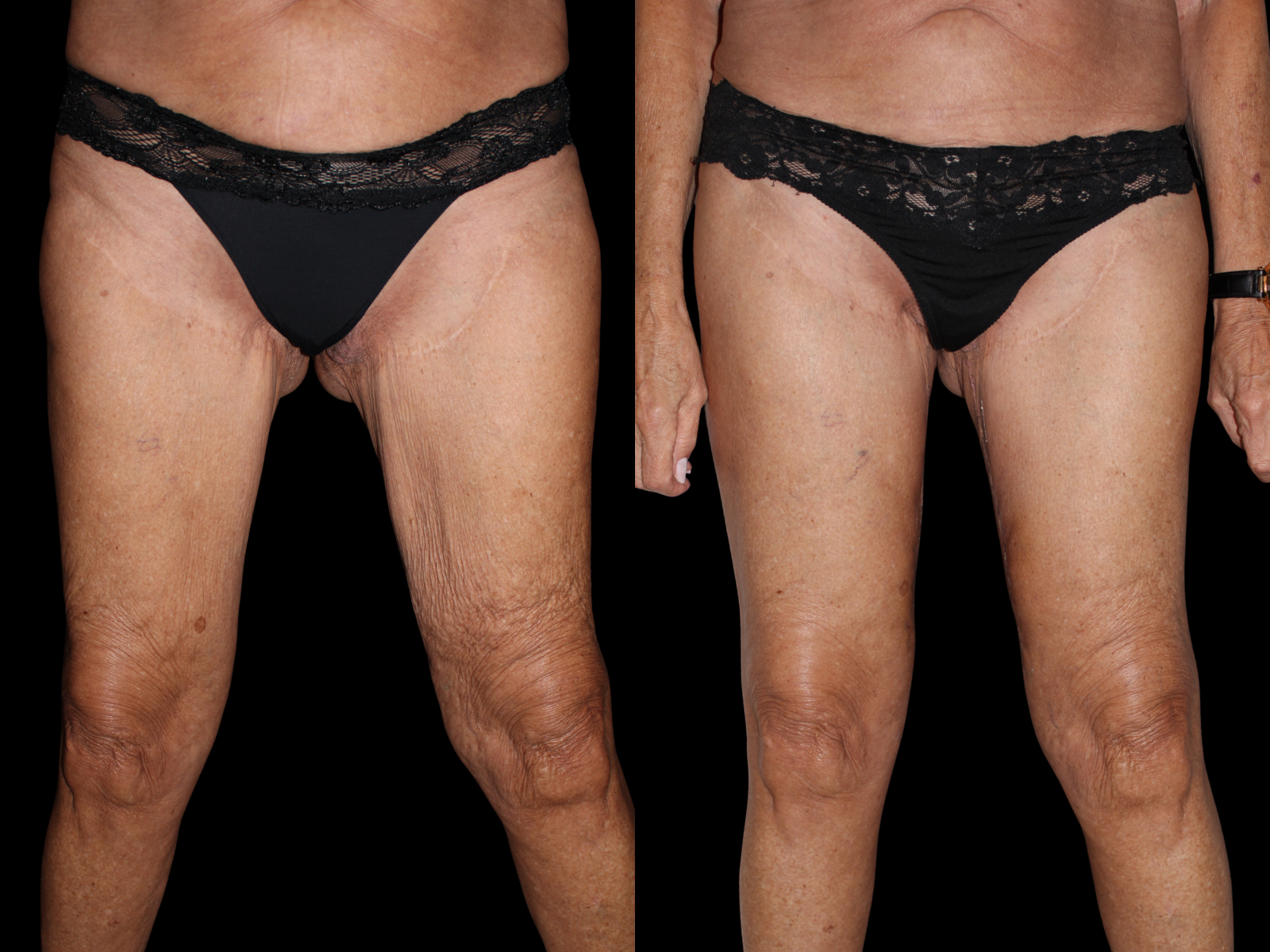 thigh-lift-dr-soler-baillo-miami-plastic-surgery