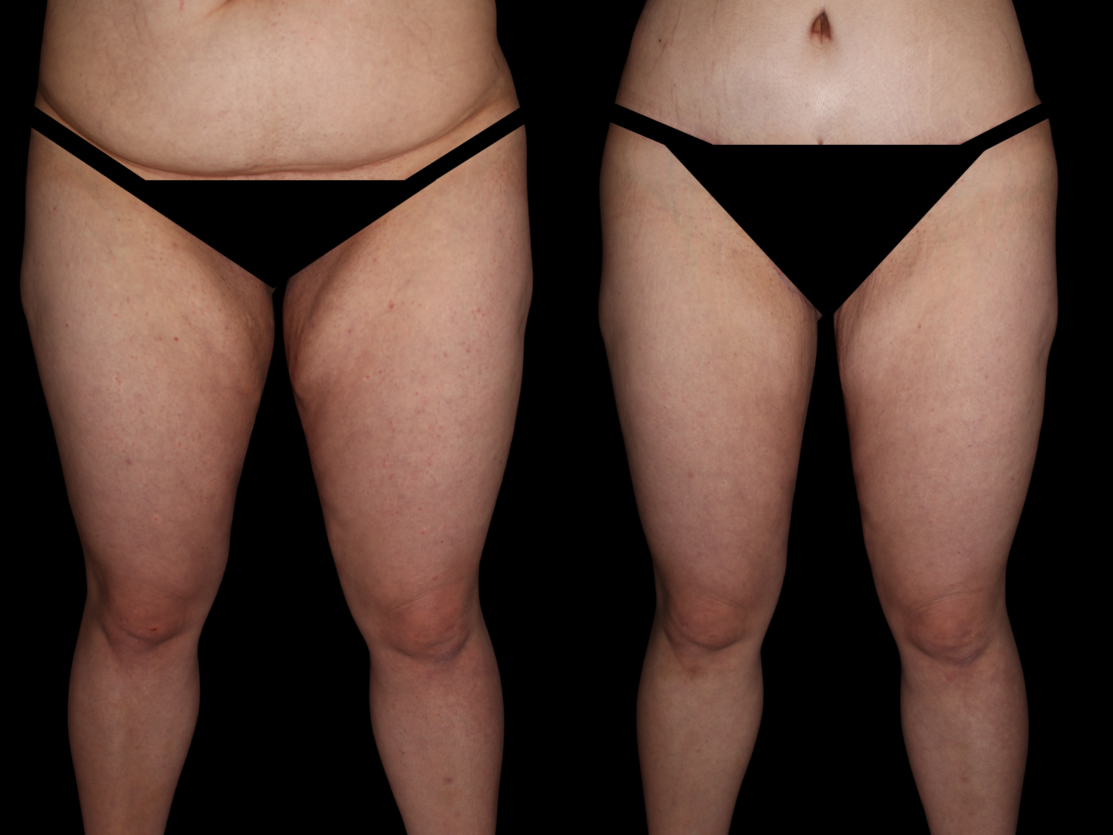 thighplasty-dr-soler-baillo-miami-plastic-surgery