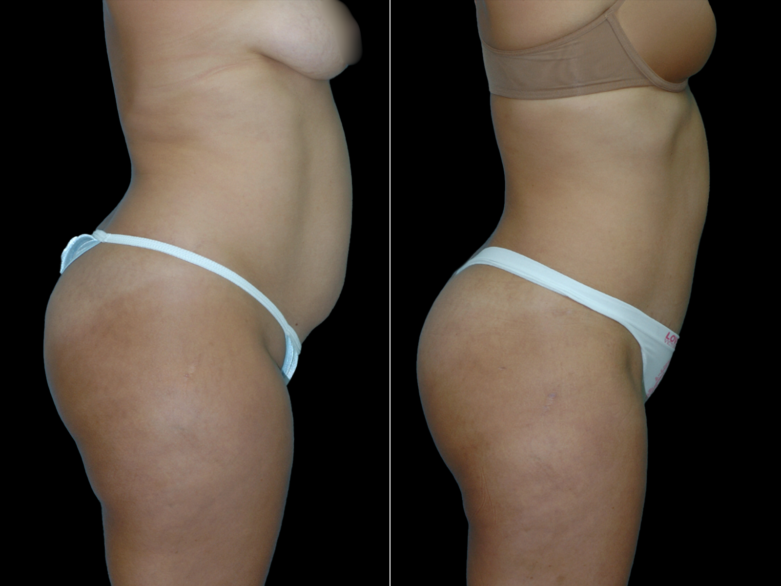 tummy-tuck-before-and-after-coral-gables-01a