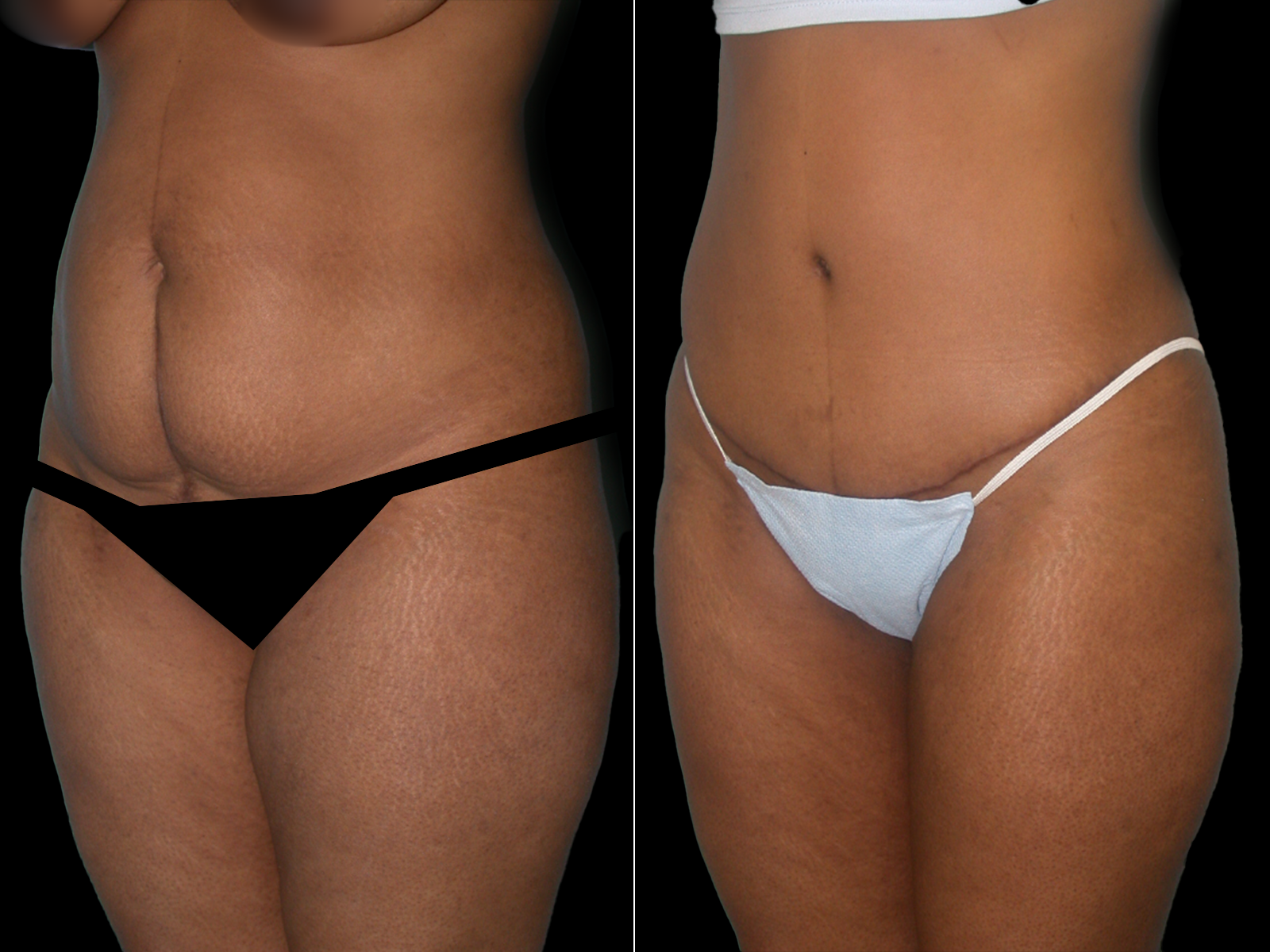tummy-tuck-before-and-after-coral-gables-02a
