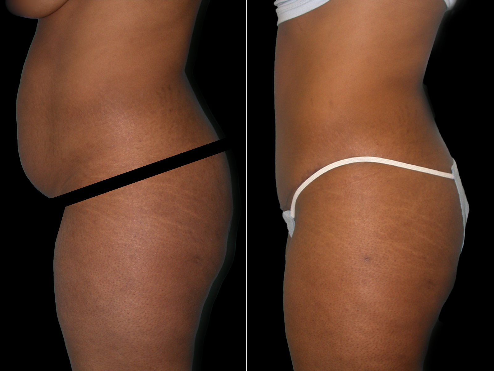 tummy-tuck-before-and-after-coral-gables-02b