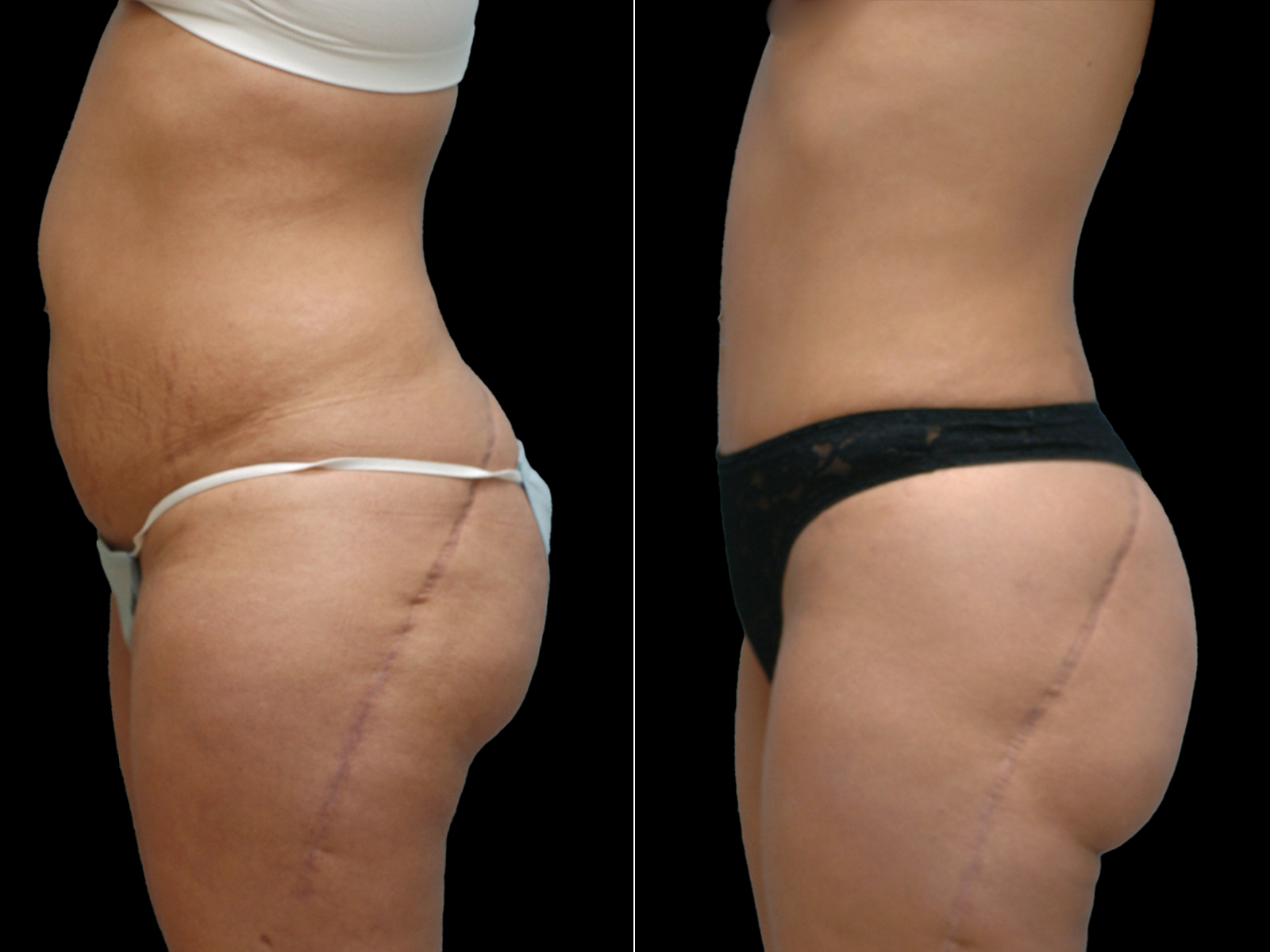 tummy-tuck-before-and-after-coral-gables-03a