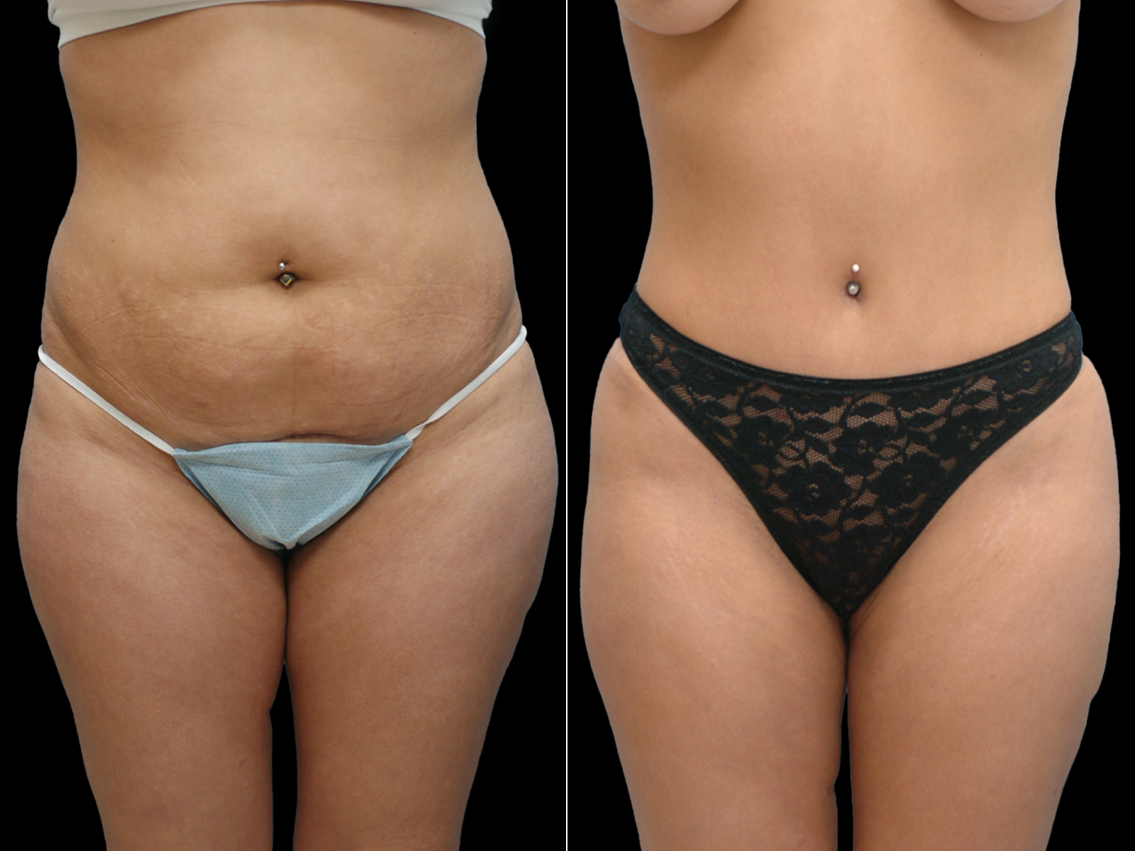 tummy-tuck-before-and-after-coral-gables-03b