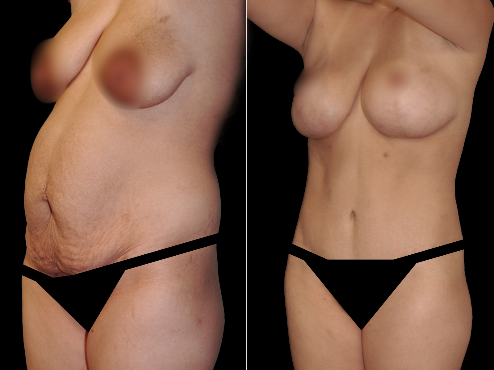 tummy-tuck-before-and-after-coral-gables-04a