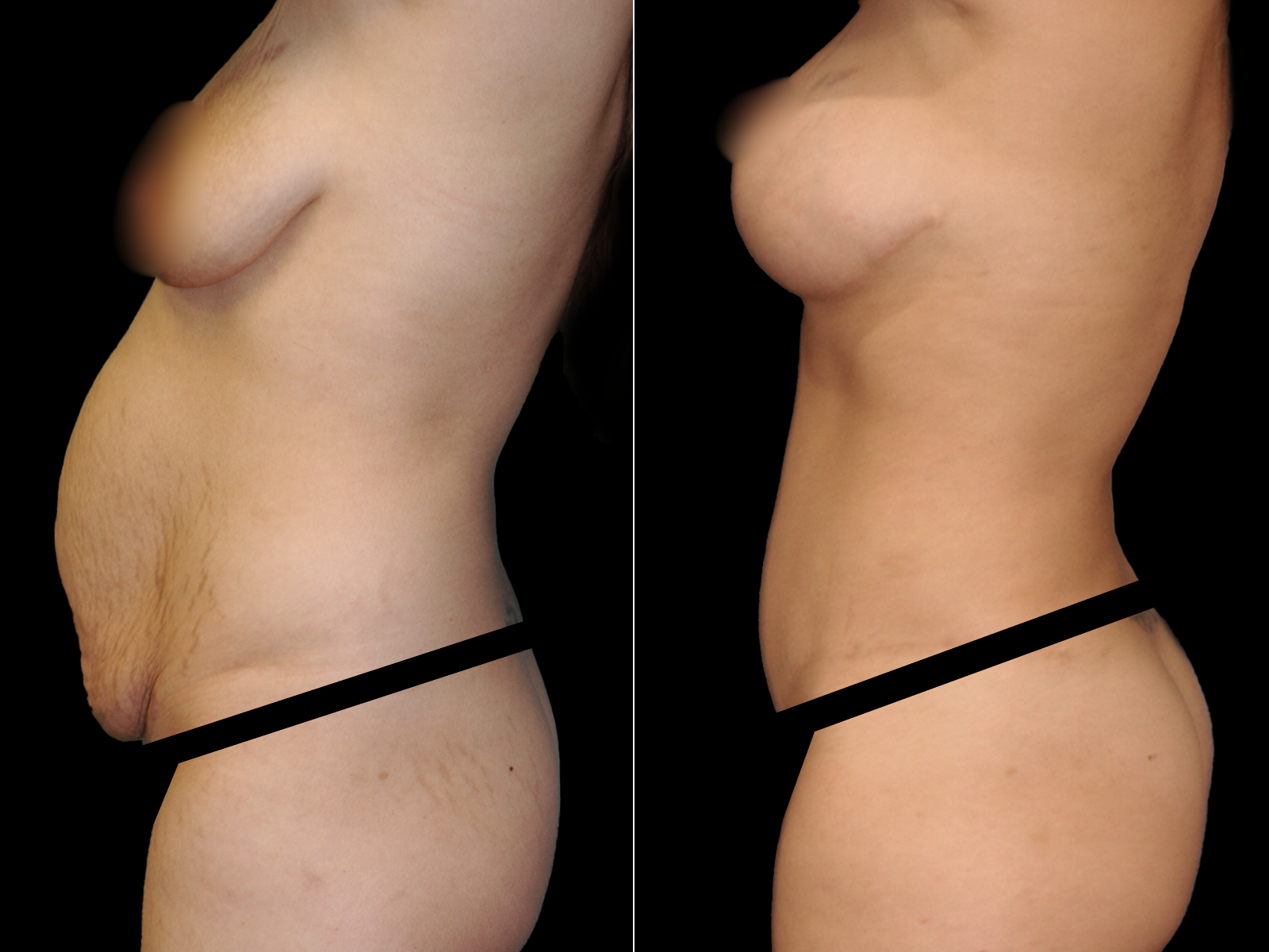 tummy-tuck-before-and-after-coral-gables-04b