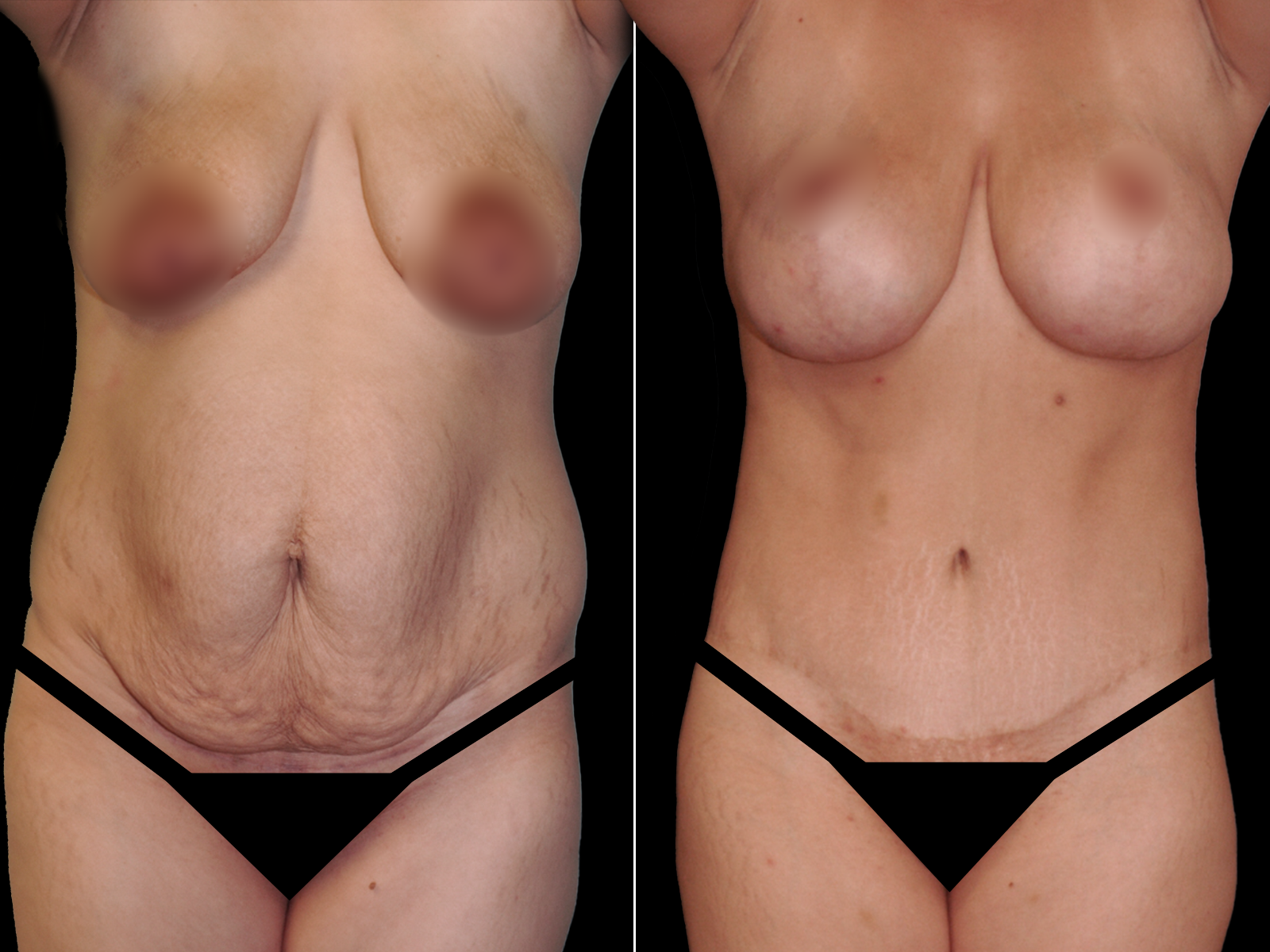 tummy-tuck-before-and-after-coral-gables-04c