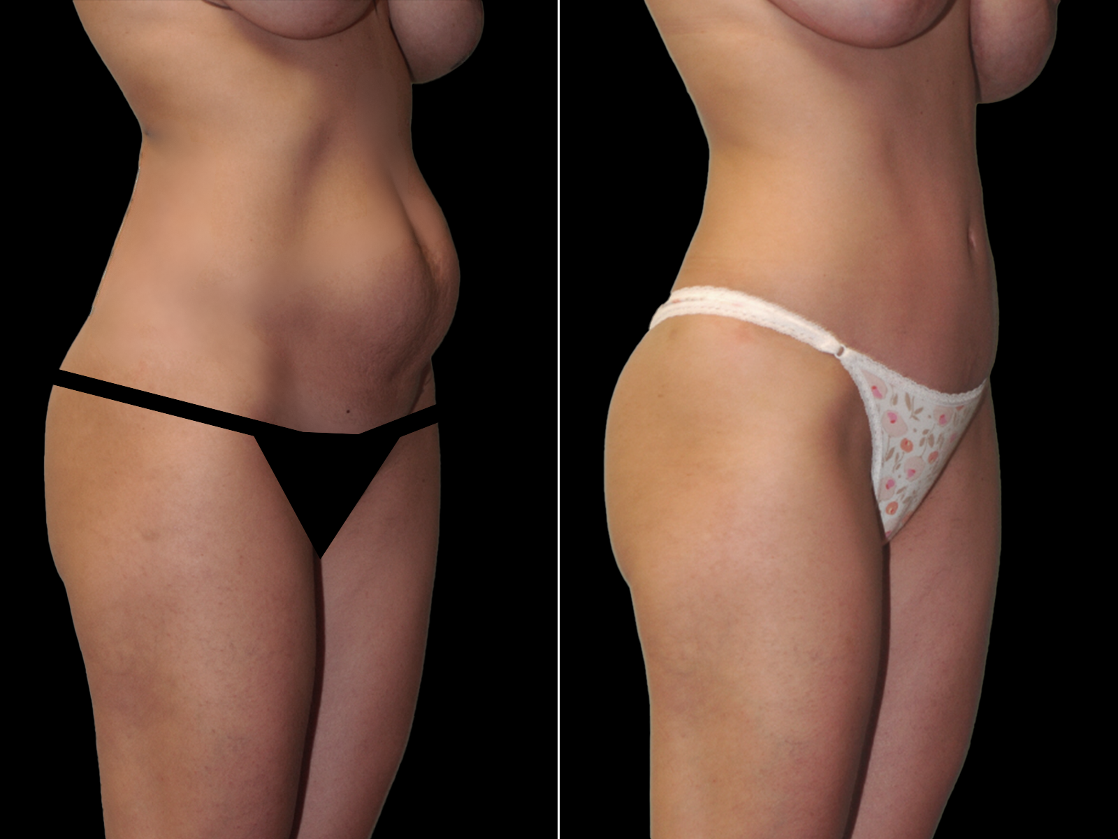 tummy-tuck-before-and-after-coral-gables-05a