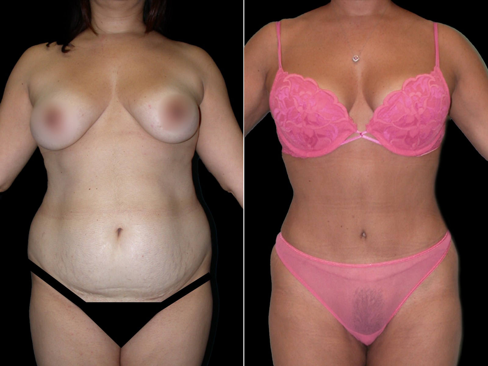 tummy-tuck-before-and-after-coral-gables-06a