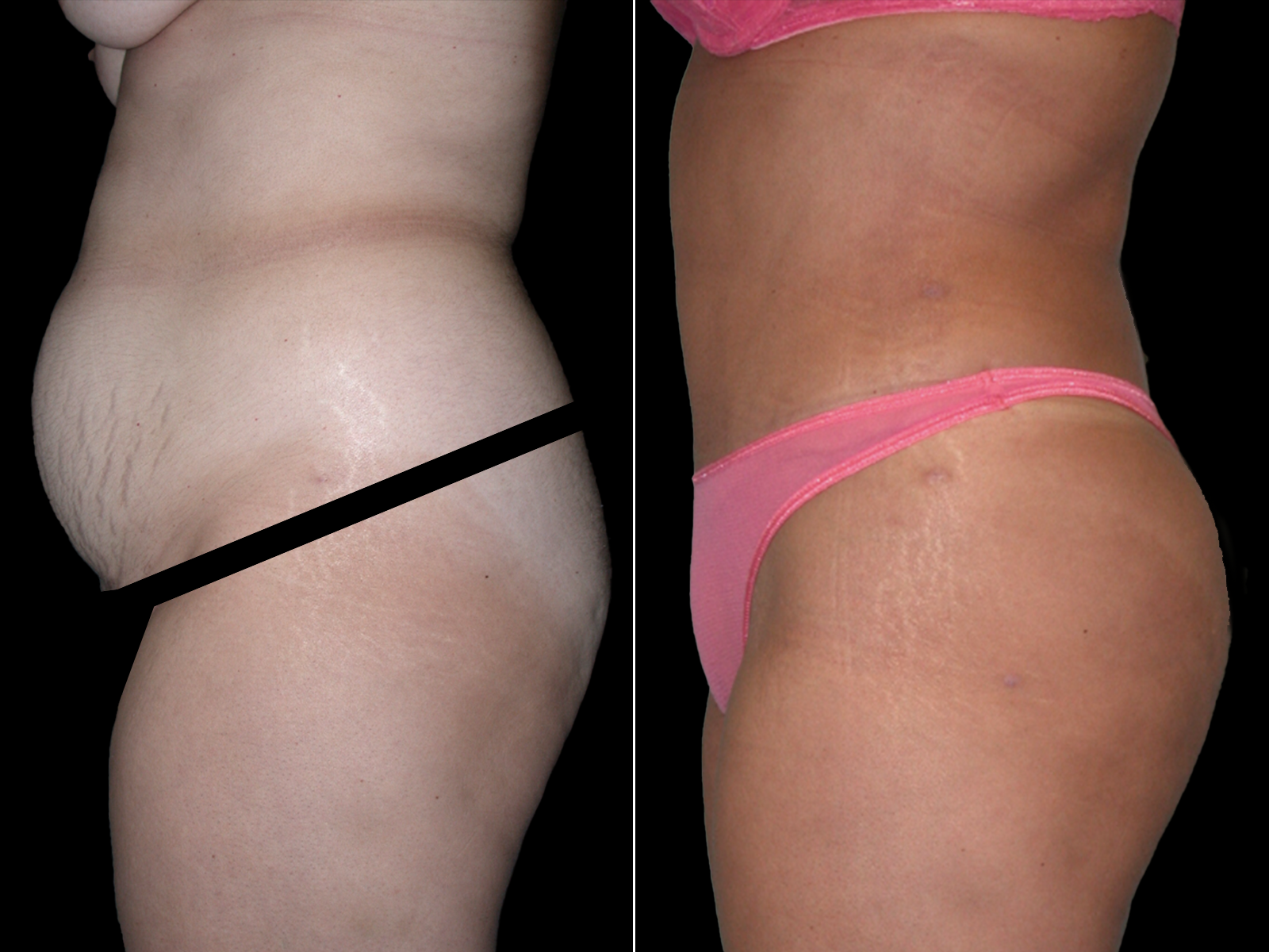 tummy-tuck-before-and-after-coral-gables-06b