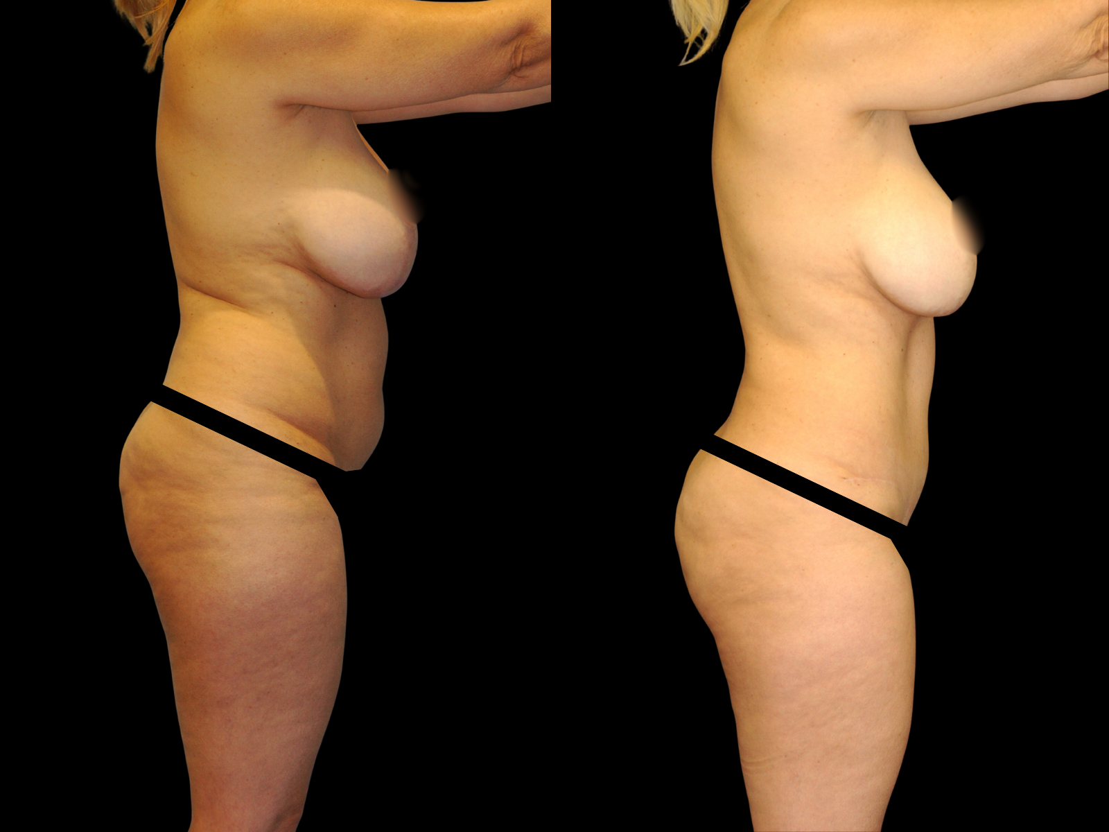 tummy-tuck-before-and-after-coral-gables-07b (1)