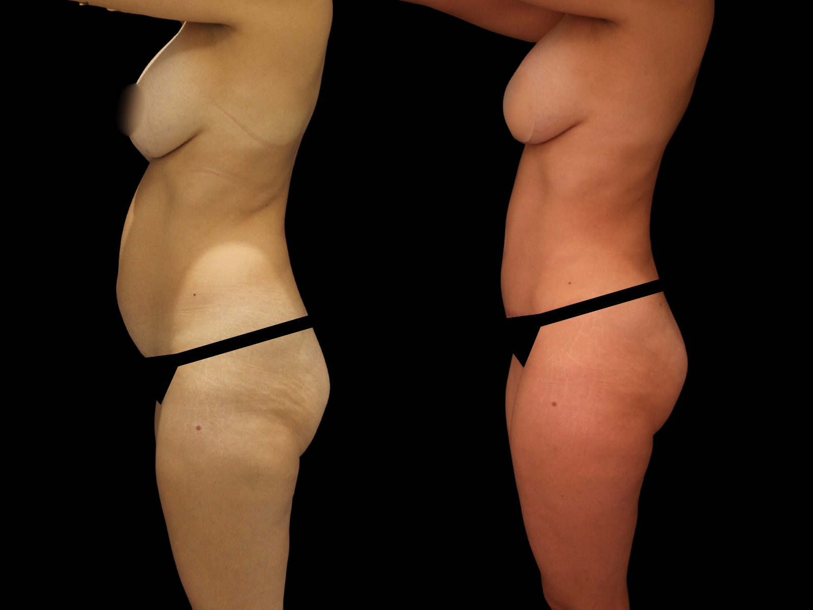 tummy-tuck-before-and-after-coral-gables-07b (2)