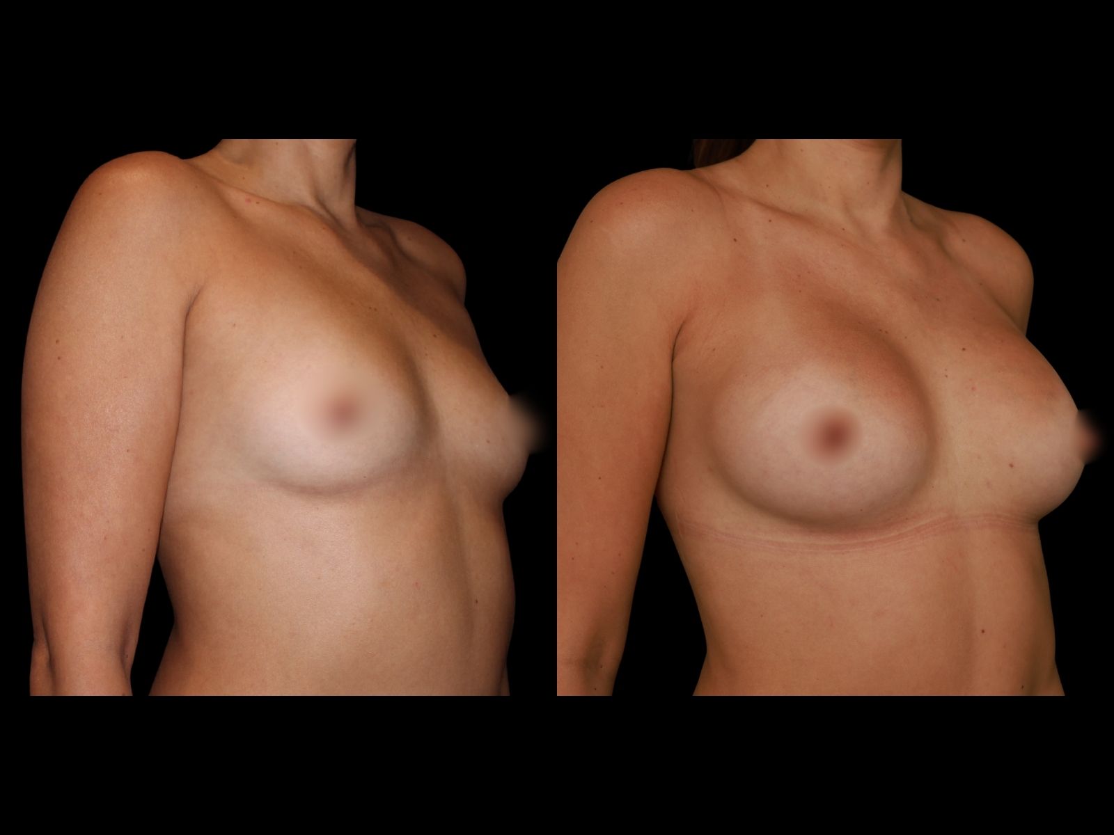breast-aug-before-and-after-miami-gm1 (1)
