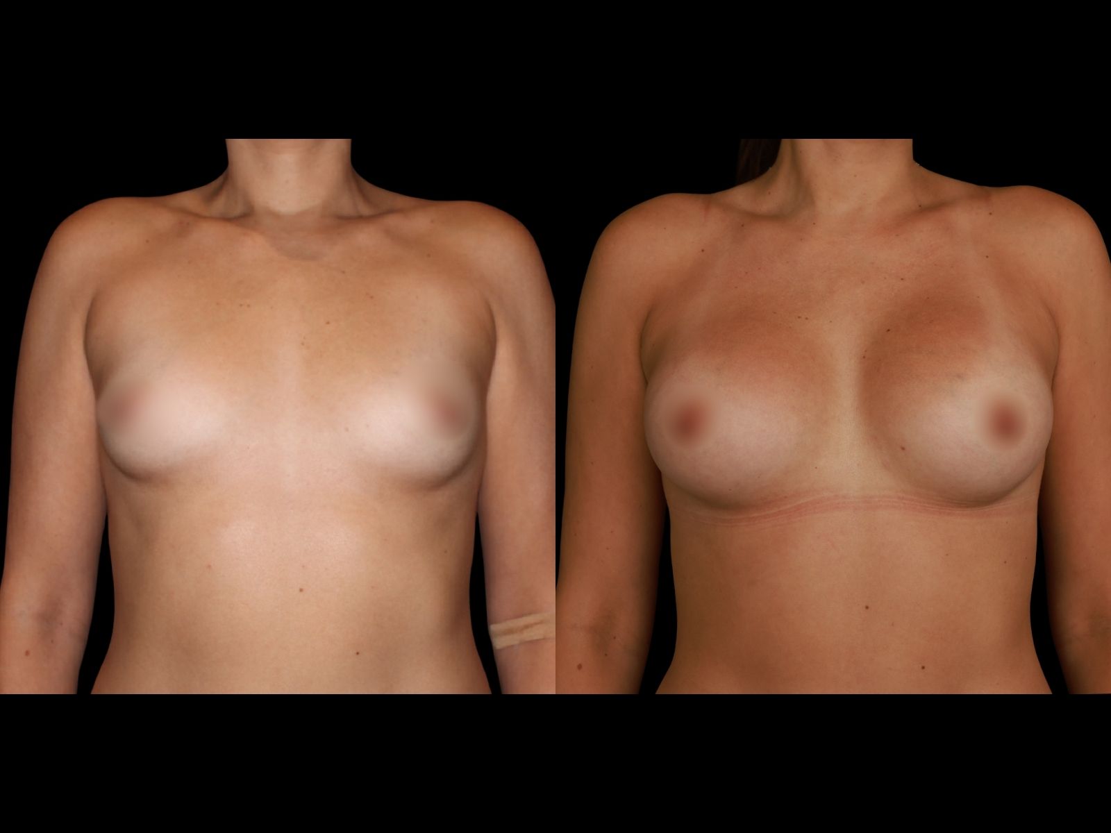 breast-aug-before-and-after-miami-gm2 (1)