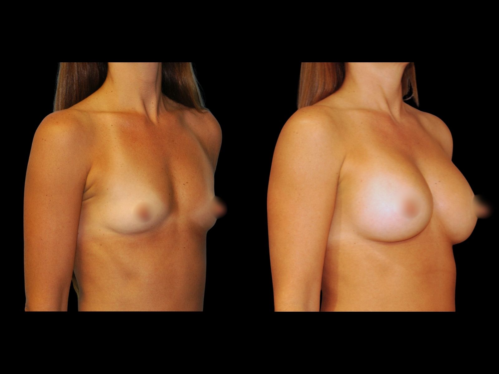 breast-aug-before-and-after-miami-kc1