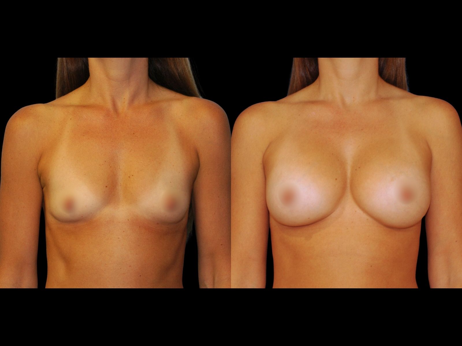 breast-aug-before-and-after-miami-kc2