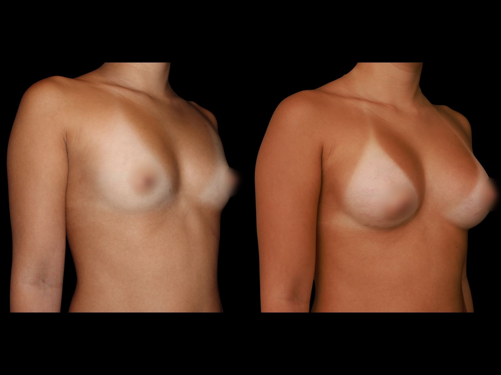 breast-aug-before-and-after-miami-mb1