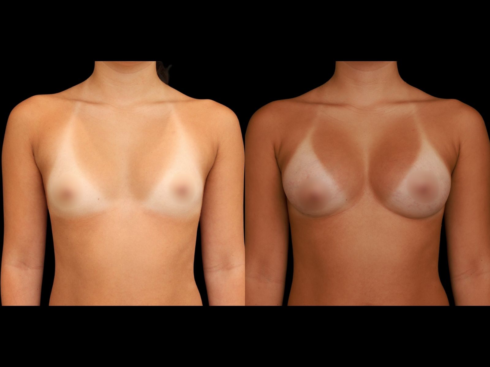 breast-aug-before-and-after-miami-mb2