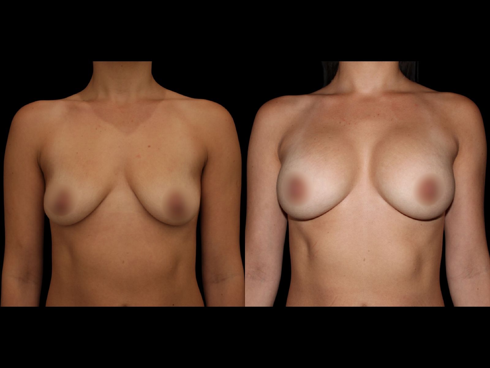 breast-aug-before-and-after-miami-sl1