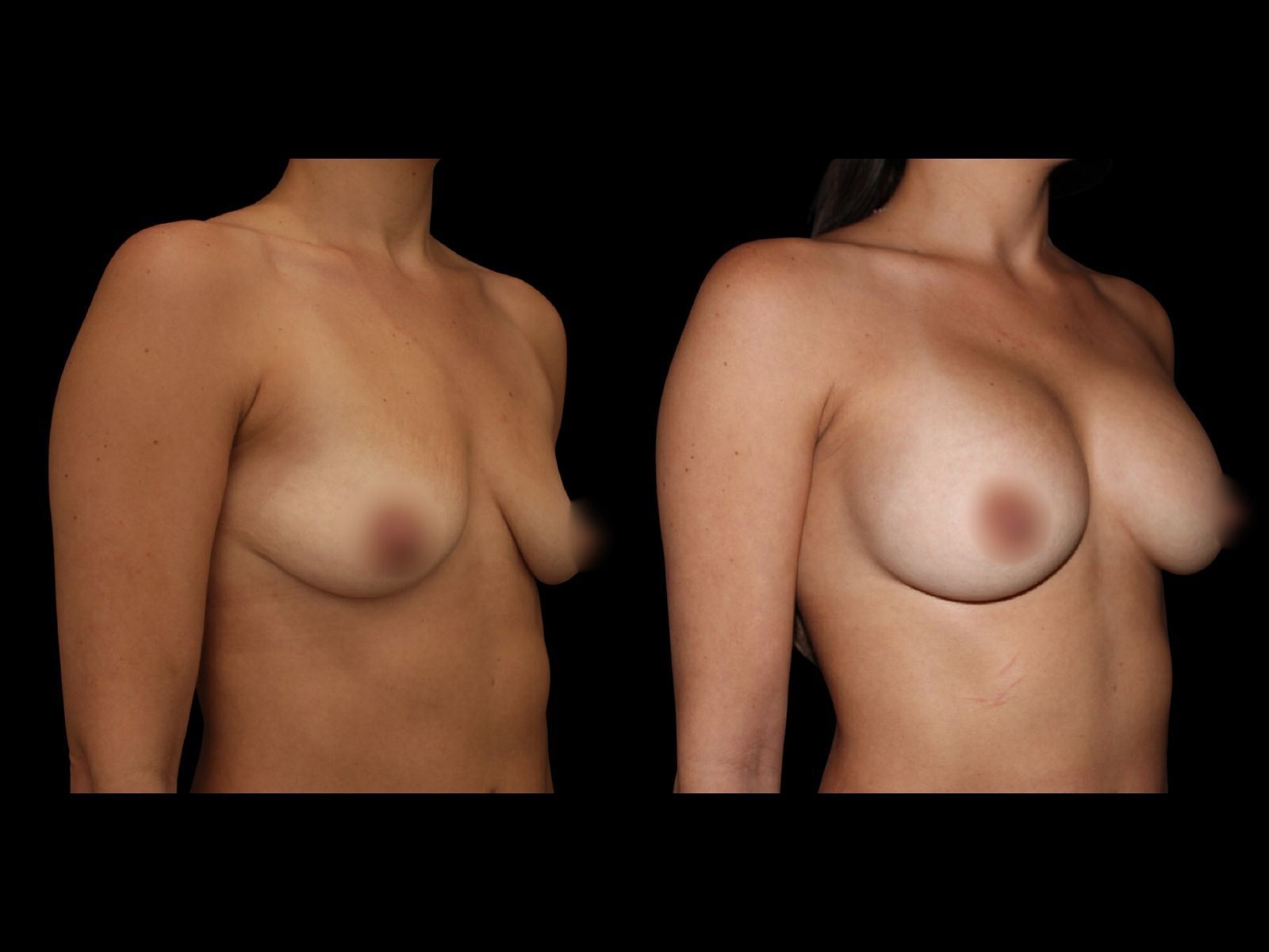 breast-aug-before-and-after-miami-sl2