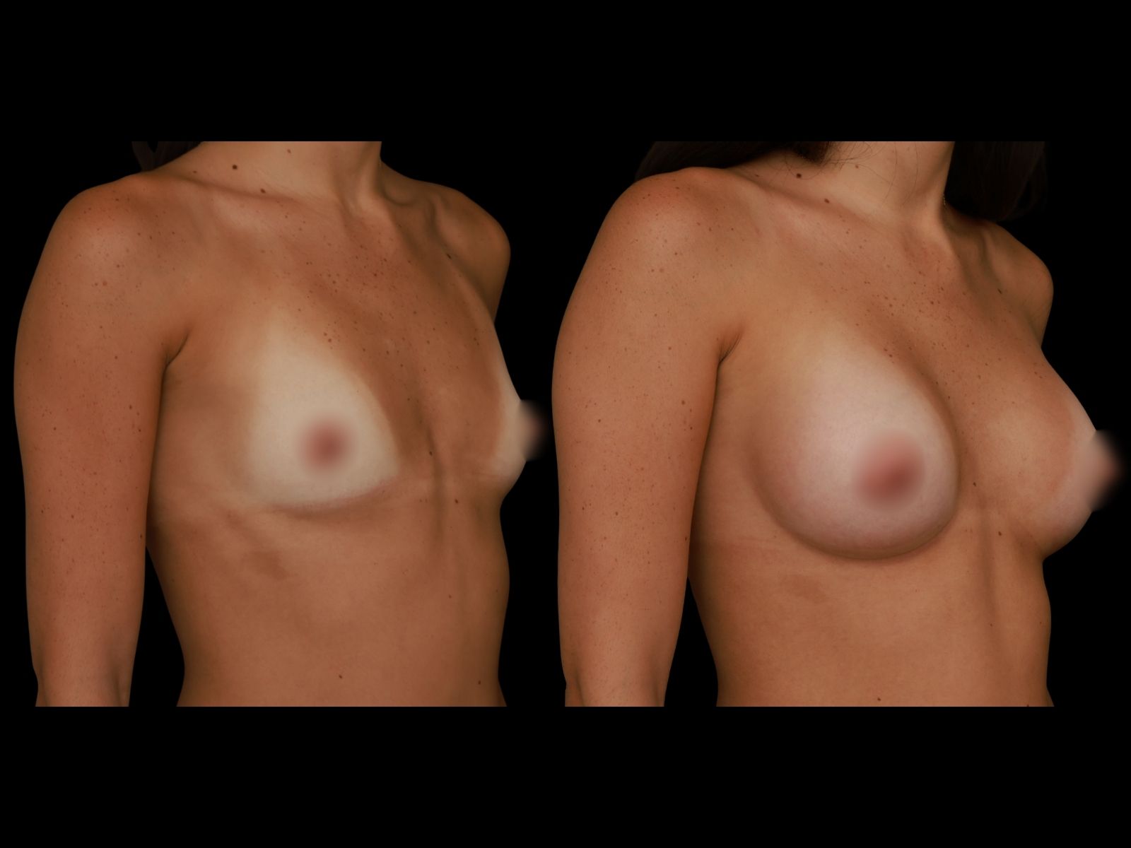 breast-aug-periareolar-before-and-after-miami-st1 (1)