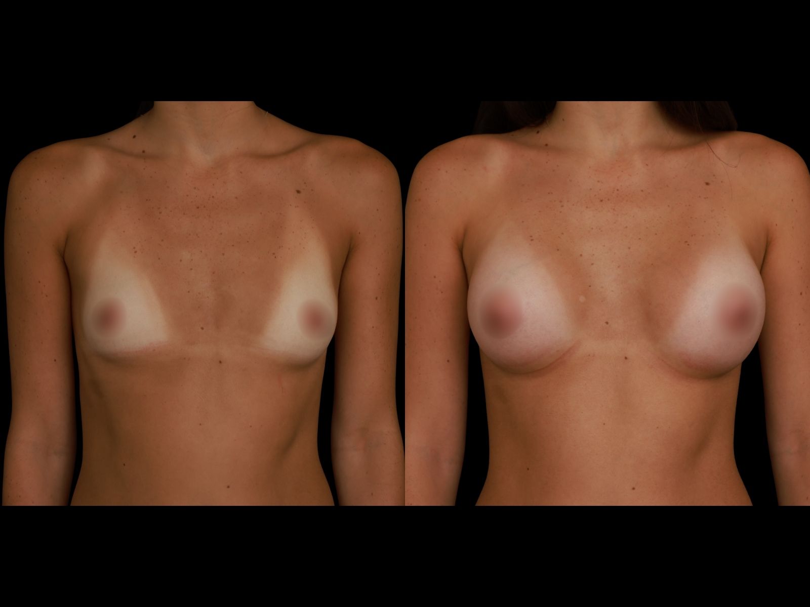 breast-aug-periareolar-before-and-after-miami-st2 (1)