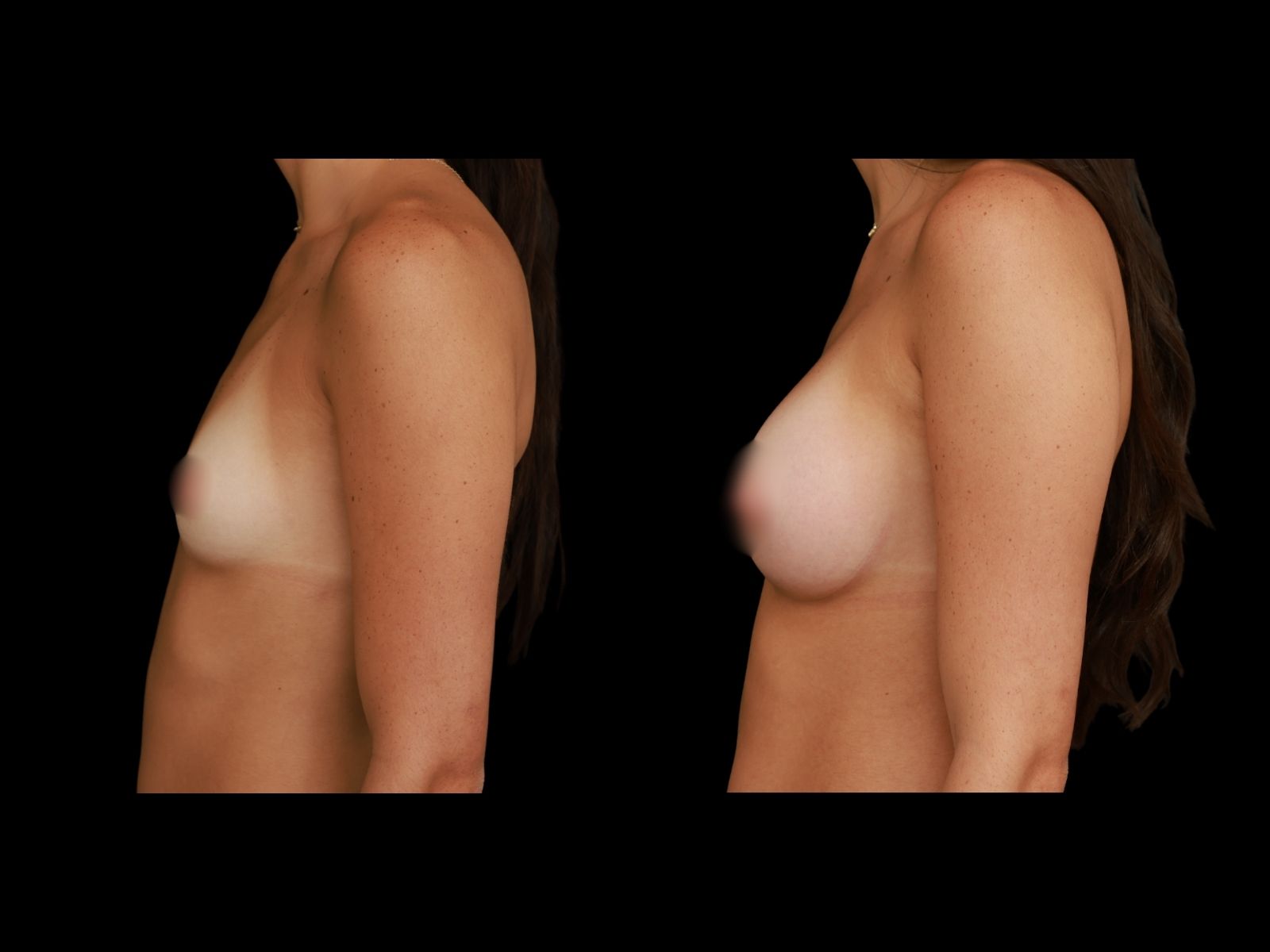 breast-aug-periareolar-before-and-after-miami-st3