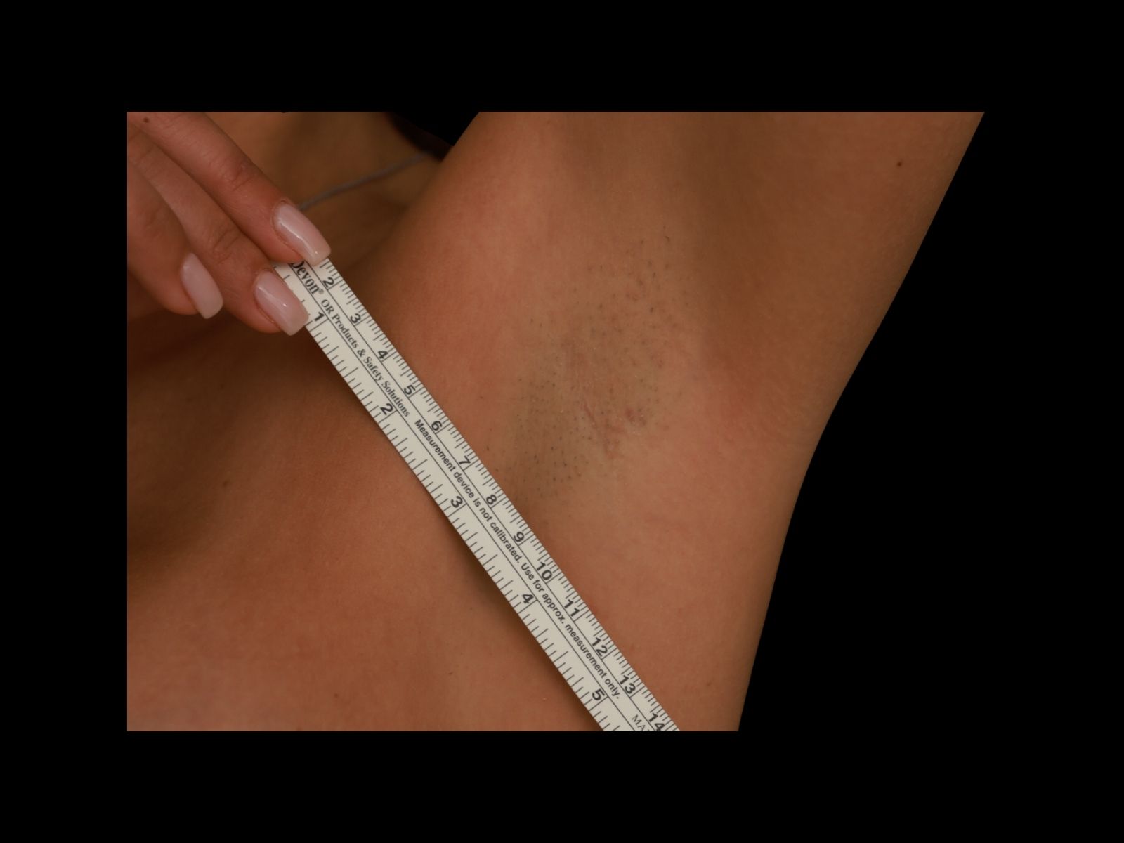 dr-soler-baillo-breast-augmentation-before-and-after-scar-gm