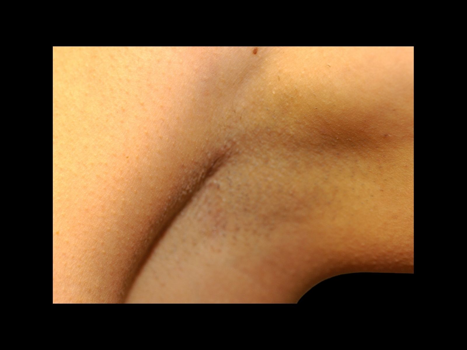 dr-soler-baillo-breast-augmentation-before-and-after-scar-kc