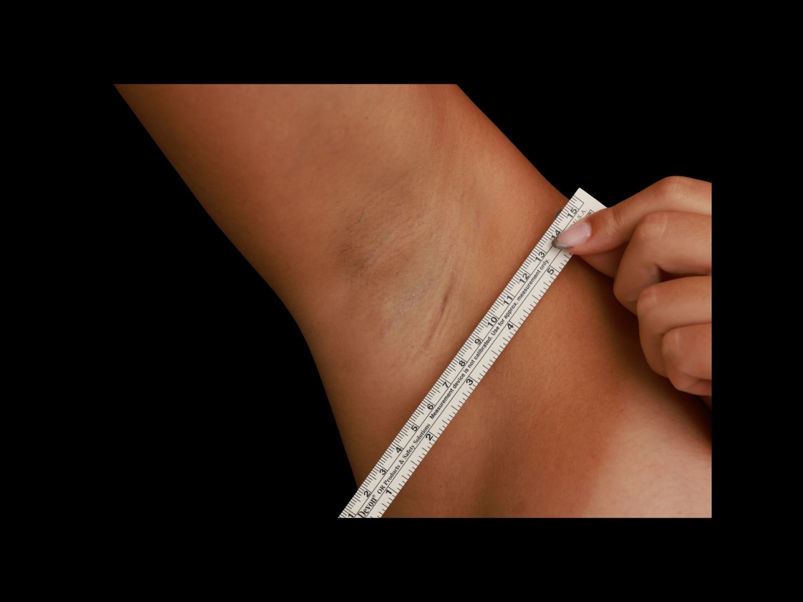 dr-soler-baillo-breast-augmentation-before-and-after-scar-mb