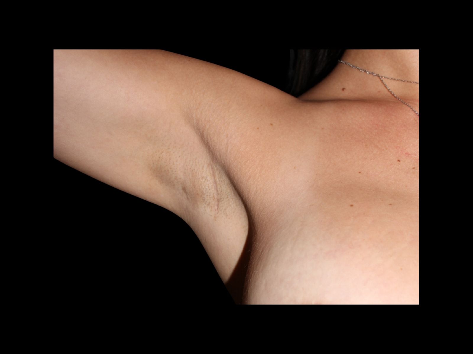 dr-soler-baillo-breast-augmentation-before-and-after-scar-sl
